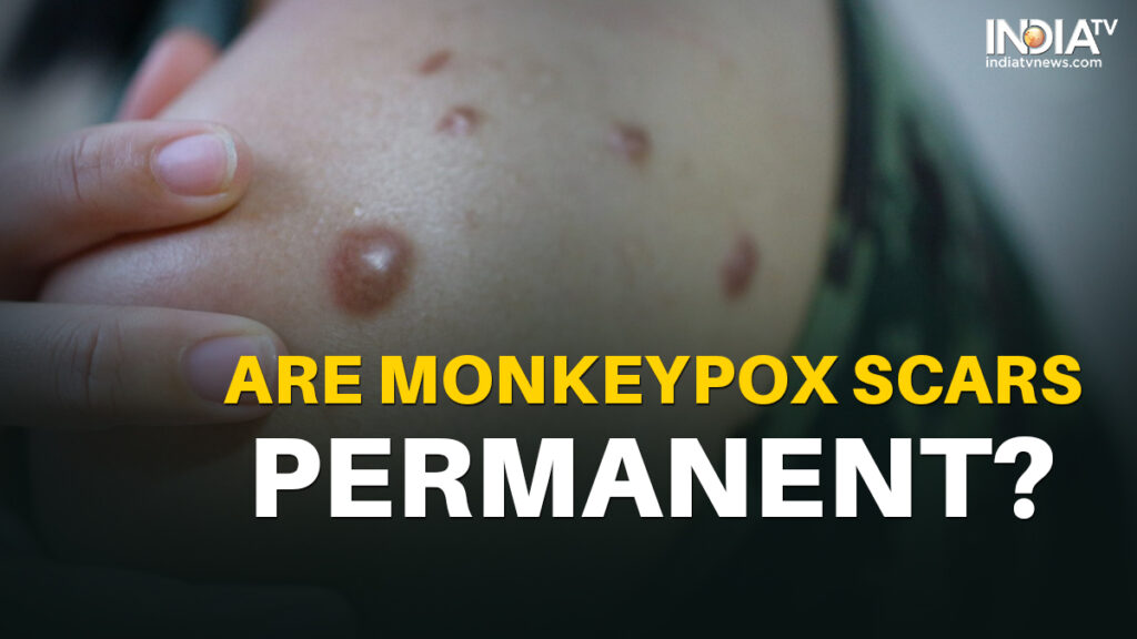 monkeypox scars